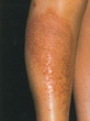 Asteatotic dermatitis