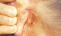 Basal cell carcinoma-rodent ulcer type