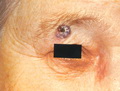 Basal cell carcinoma-pigmented