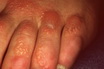 Bullous Contact Dermatitis