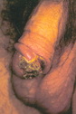 Chronic herpetic ulcer