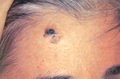 Desmoplastic melanoma