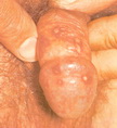Genital herpes simplex
