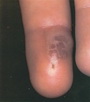 Herpes simplex-fingers
