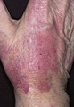 Contact Dermatitis-Irritant