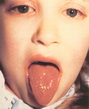 Kawasaki disease-tongue