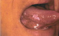 Lichen planus-tongue