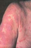 Mycosis fungoides-CTCL-plaque stage