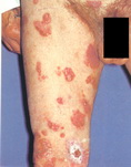 Mycosis fungoides-CTCL