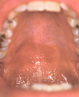 Oral candidiasis-atrophic