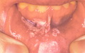 Oral candidiasis-pseudomembranous