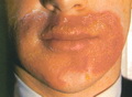 Perioral contact eczematous dermatitis due to balsam of Peru