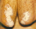 Psoriasis vulgaris
