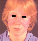 Systemic lupus erythematosis-butterfly rash