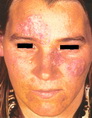 Systemic lupus erythematosis-chronic cutaneous