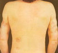 Systemic lupus erythematosis-chronic Panniculitis