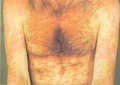 Systemic lupus erythematosis-subacute cutaneous