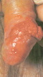 Squamous cell carcinoma-penis
