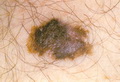 Superficial melanoma
