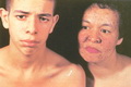 Tuberous sclerosis-mother and son