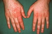 Contact Dermatitis-Vesicular