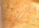Acne-ice pick scar