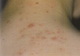 Acne- papules and pustules - neck
