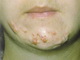 Acne - thickened scar- keloid
