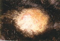 Kerion-scalp