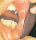 Behcet's syndrome-ulcer-oral