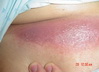 Dermatitis - Sub-Phrenic abscess
