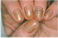 Yellow nail syndrome - Transverse over-curvature